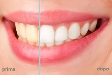 sbiancamento denti